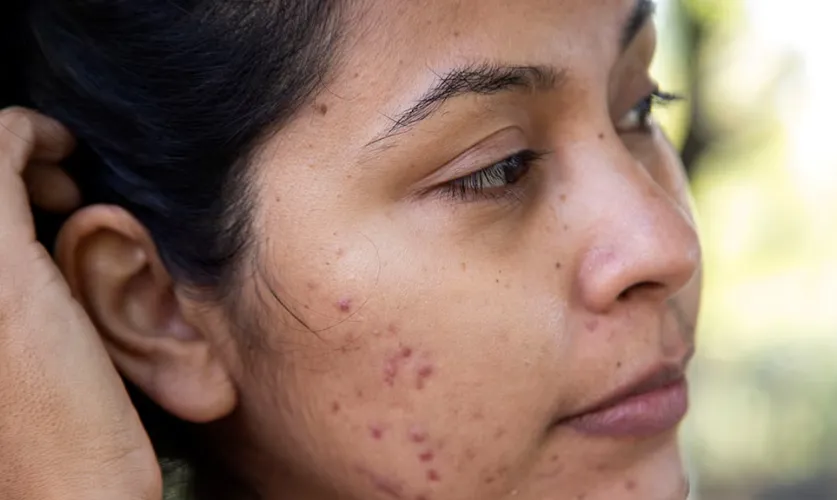 Acne & Acne Scars Treatment