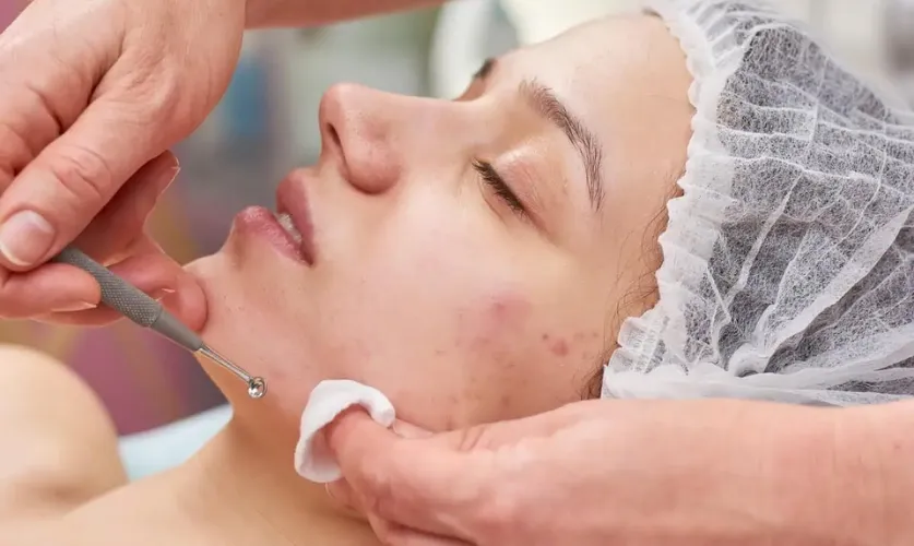 Acne Treatment