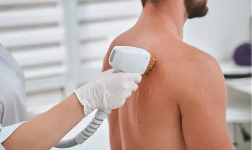 Laser Toning for Back Treatment