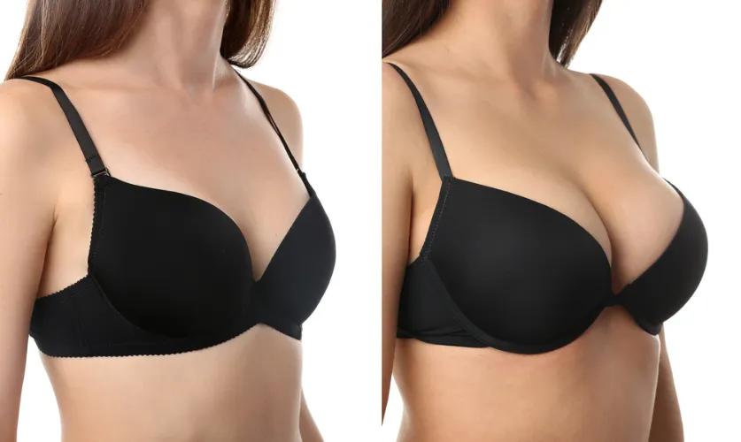 Breast Augmentation Surgery