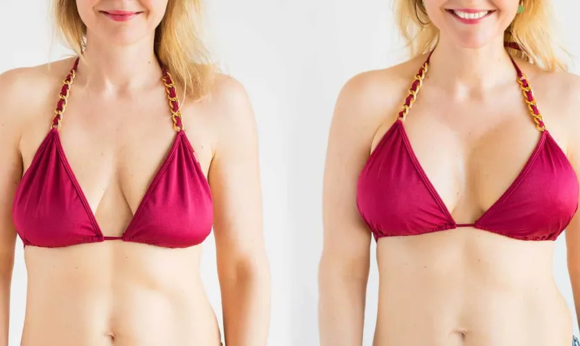 Breast Lift Surgery
