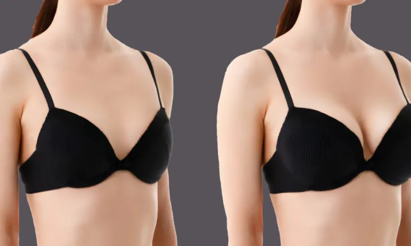 Breast Reduction Surgery