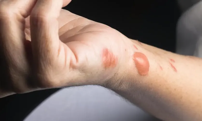 Burn Mark Treatment