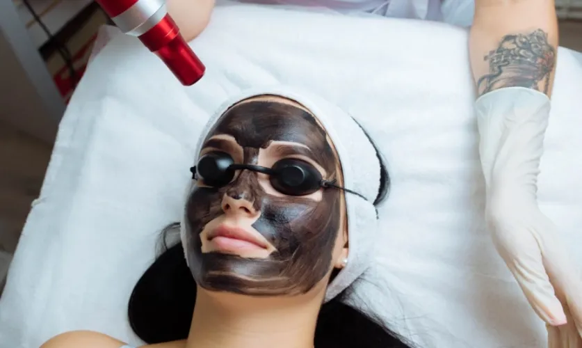 Carbon Laser Facial Treatment