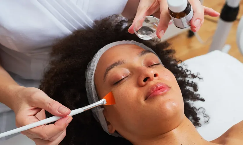 Chemical Peels Treatment