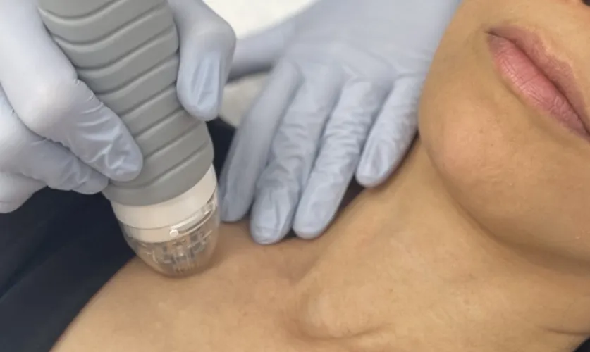 Chest Peel Treatment