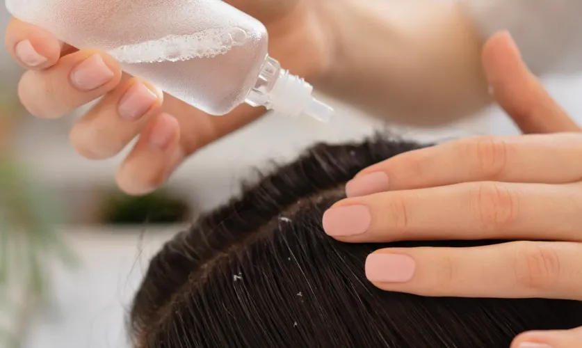 Dandruff Treatment