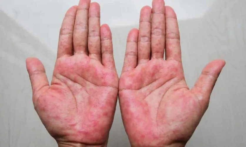 Eczema Treatment