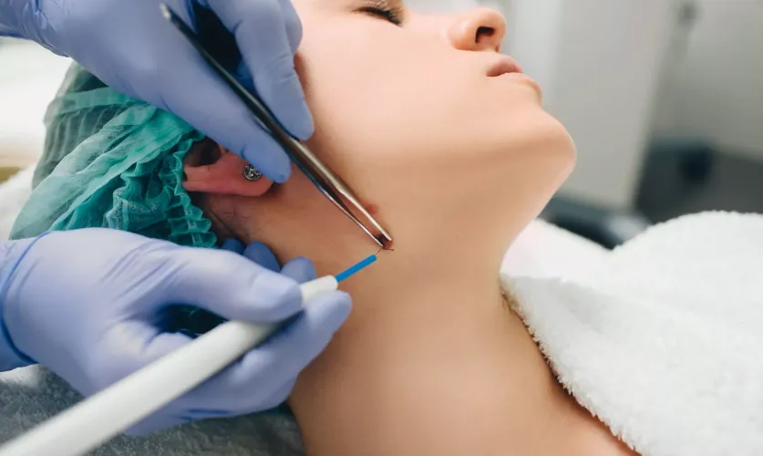 Electrocautery Treatment