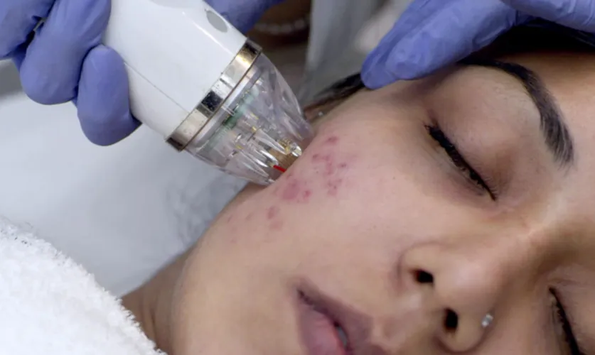 Face Scars Treatment