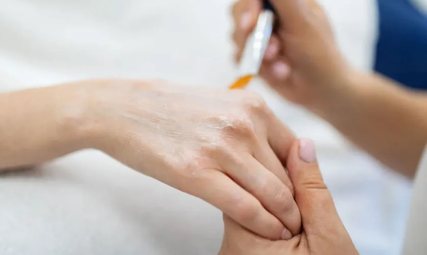 Full Hand Peel Treatment