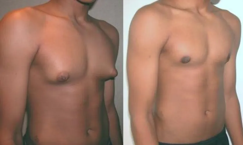 Gynaecomastia Treatment