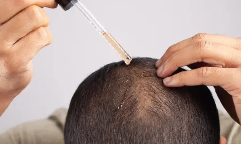 Hair Loss Treatment