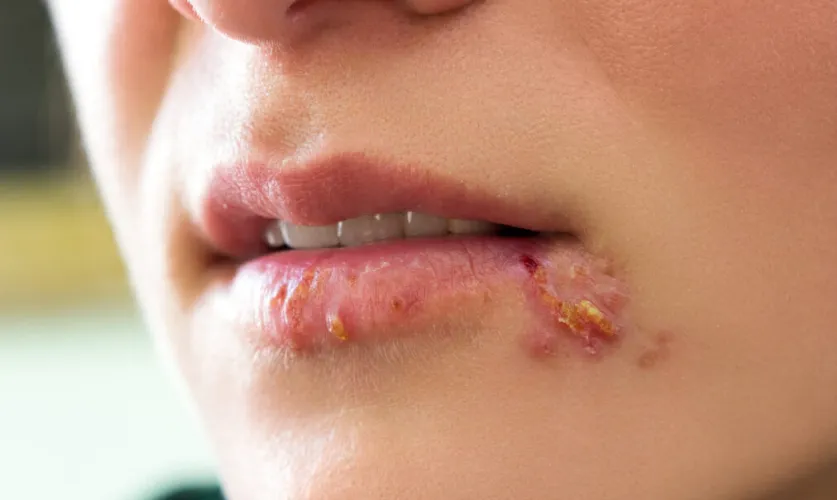 Herpes Treatment