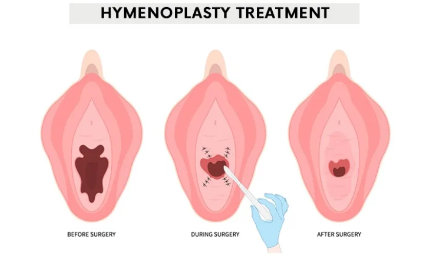 Hymenoplasty Surgery
