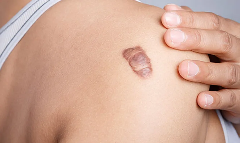 Keloid Treatment