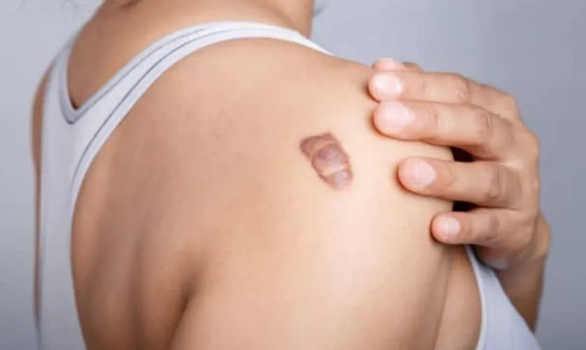 Keloids & Warts Treatment