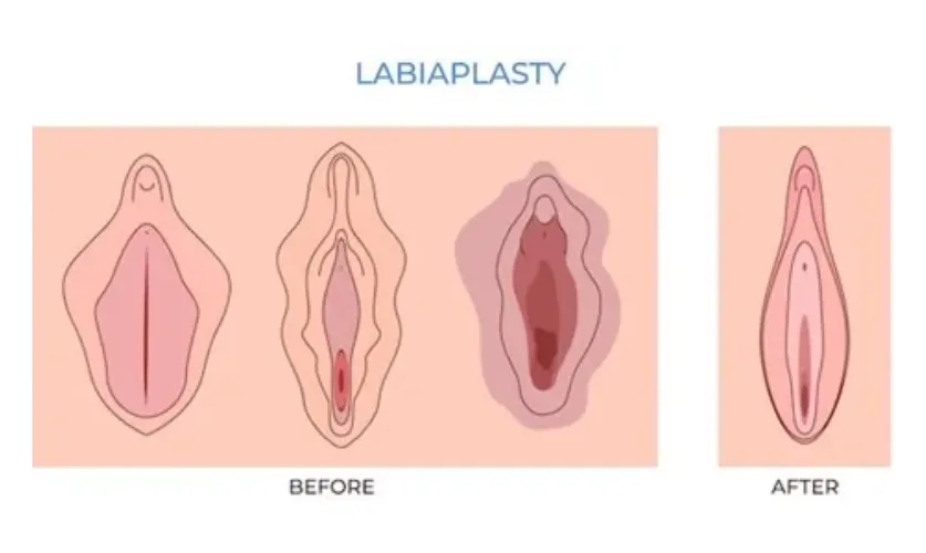 Labiaplasty Surgery