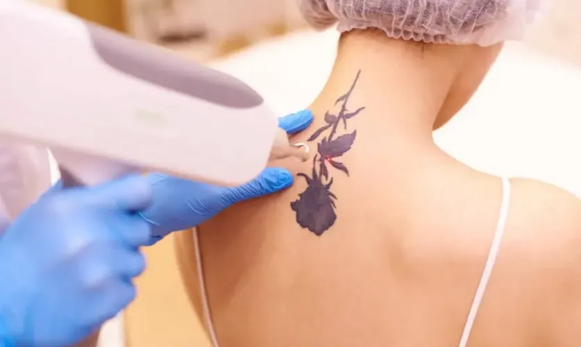 Laser Tattoo Removal Treatment