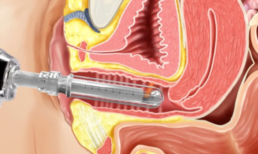 Laser Vaginal Tightening Treatment