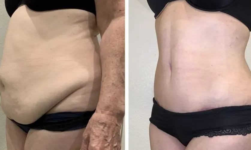 Liposuction Surgery