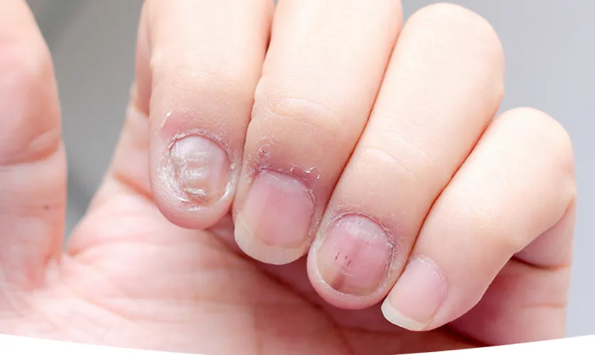 Nail Infections Treatment