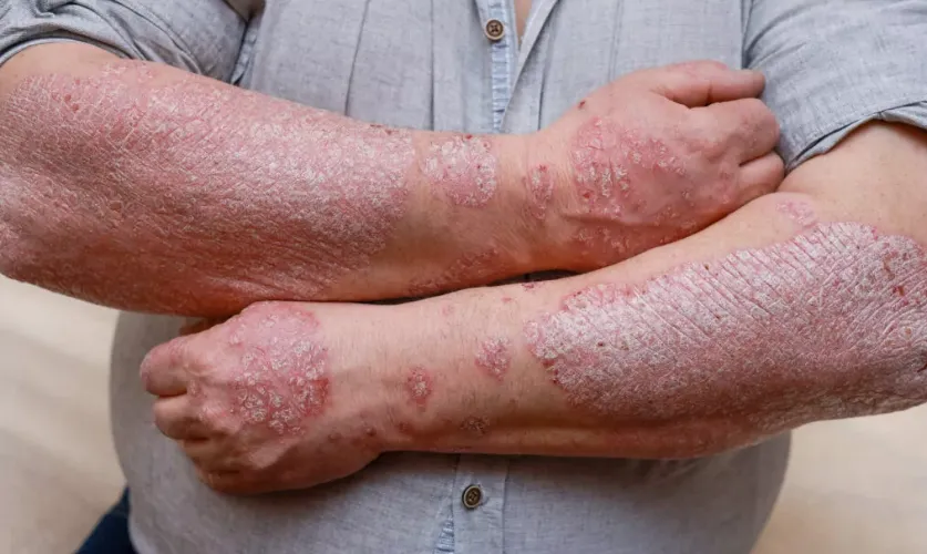 Psoriasis Treatment
