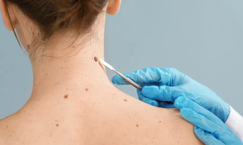 Skin Tag / Mole / Wart Removal Treatment