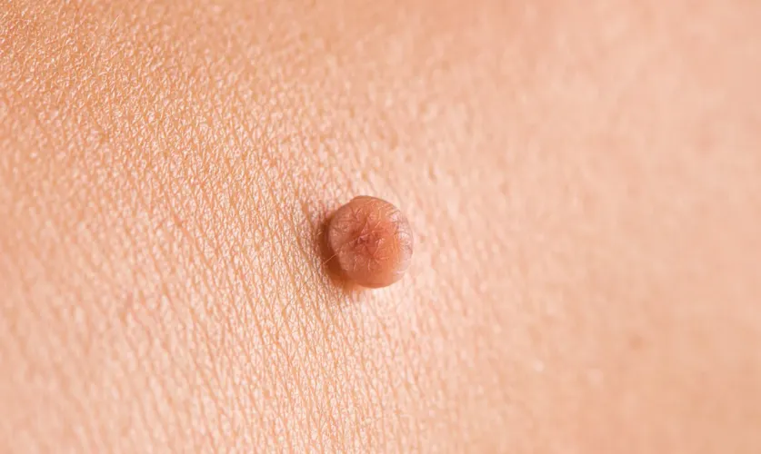 Skin Tags Treatment