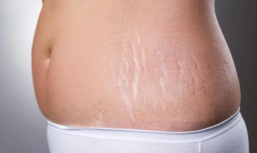 Stretch Mark Removal Treatment