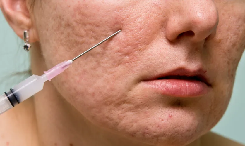 Subcision Treatment