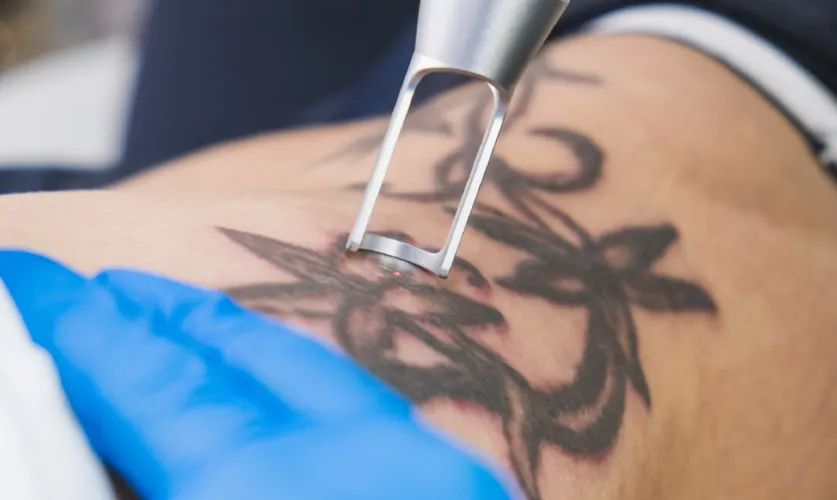Tattoo Removal Treatment