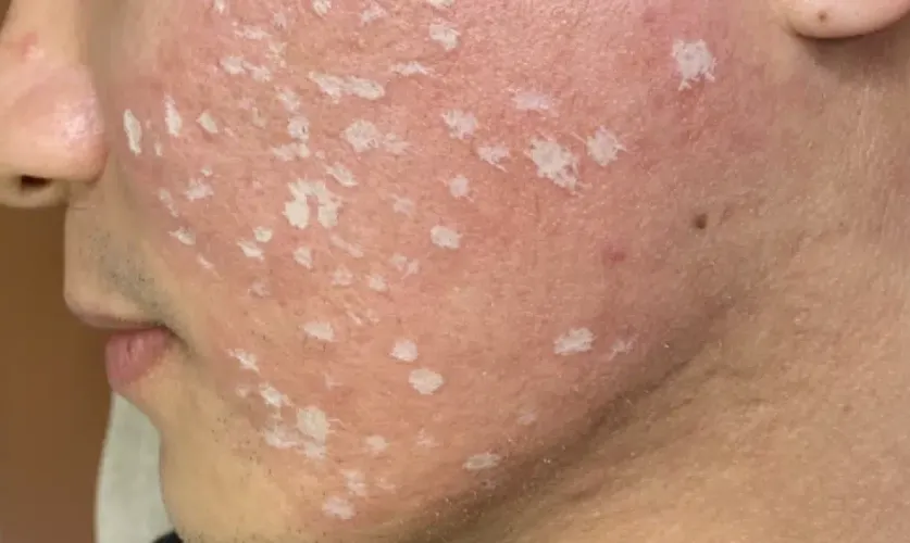 TCA Cross Treatment
