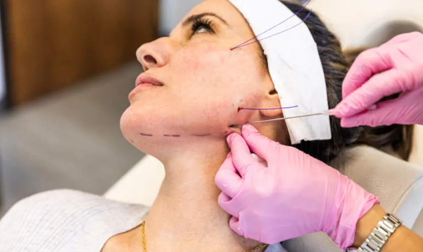 Thread Lift Treatment