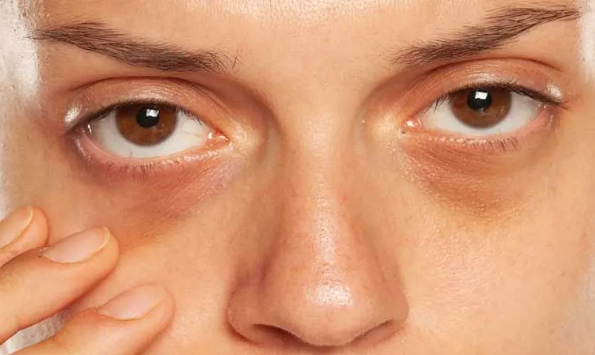 Under Eye Pigmentation Treatment