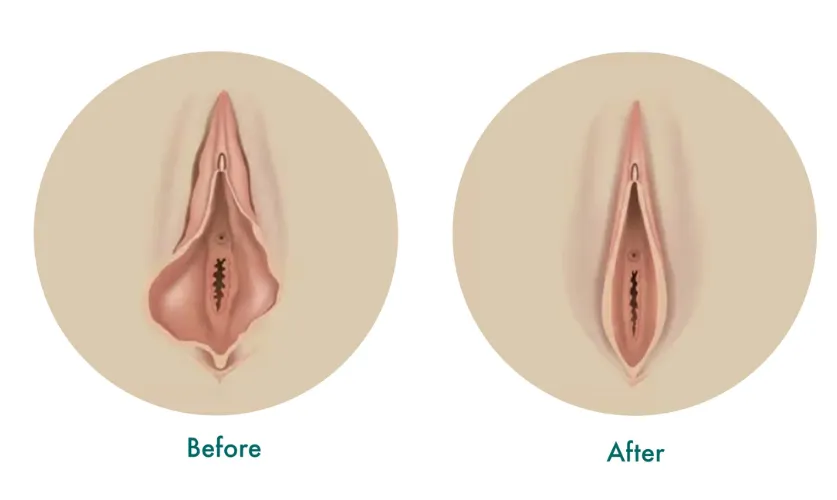 Vaginal Tightening Surgery