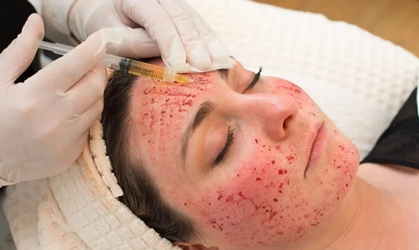 Vampire Facial Treatment