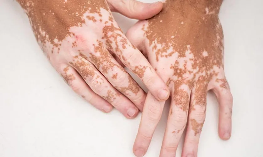 Vitiligo Treatment