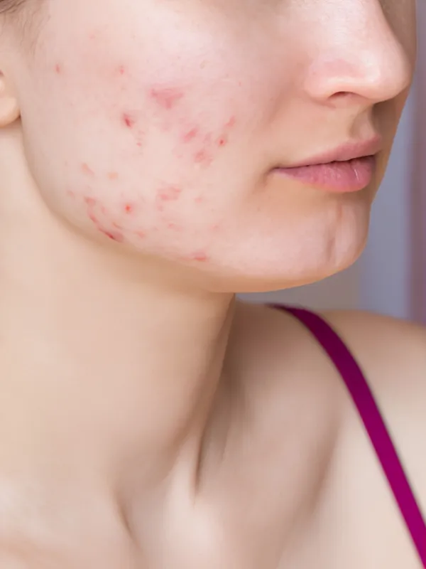 After skin rejuvenation