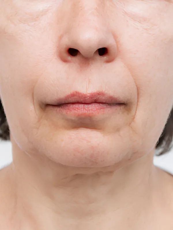 After acne treatment