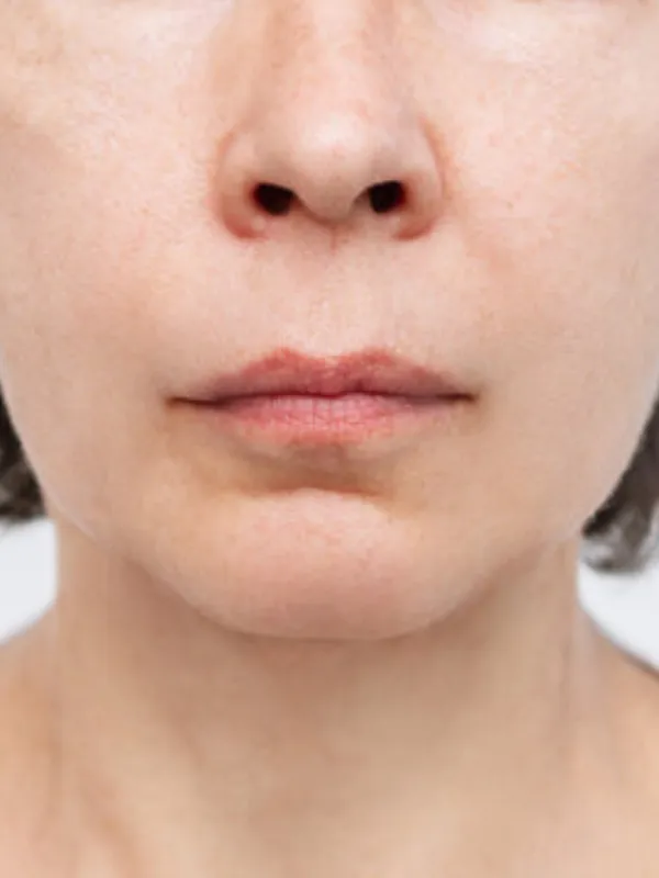 Before acne treatment
